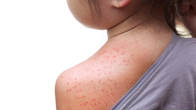 Florida Department of Health says Pasco County measles case has been 'ruled out'