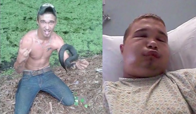 Floridaman tries to kiss venomous snake and is immediately bitten on the lips